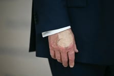 Trump’ın elinde makyajla gizlenen kırıklar sağlık tartışmalarını yeniden alevlendirdi