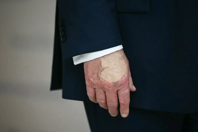 Trump’ın elinde makyajla gizlenen kırıklar sağlık tartışmalarını yeniden alevlendirdi