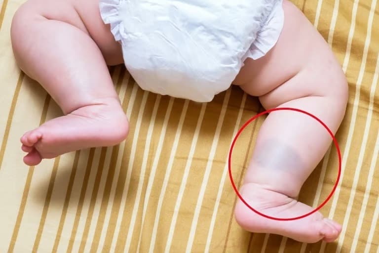 Çocuğunuzun vücudundaki kahverengi lekelere dikkat!