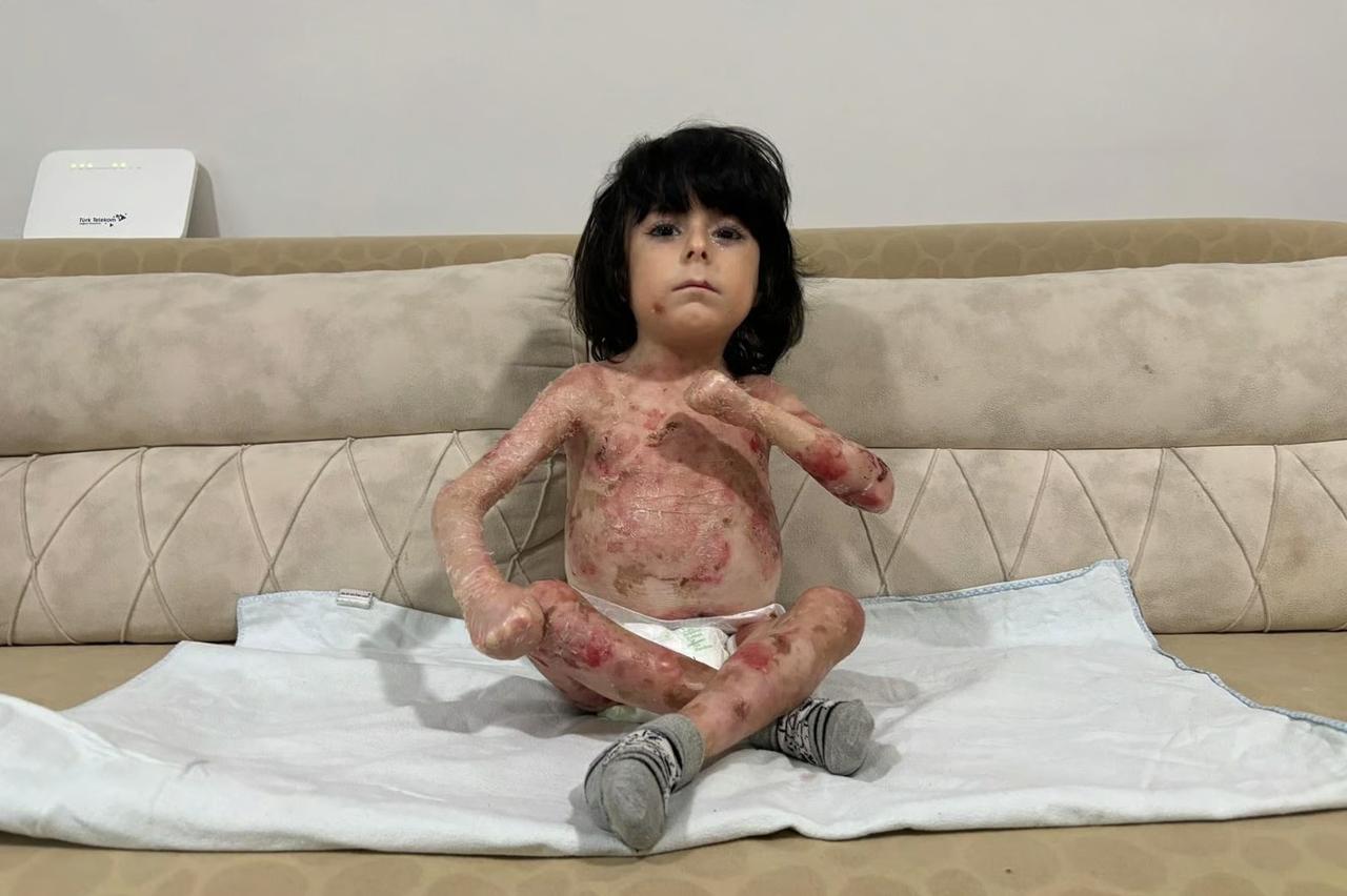 Kelebek hastası minik İbrahim'in acı dolu yaşamı