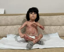 Bursa’da yürek yakan dram: Kelebek hastası minik İbrahim'in acı dolu yaşam mücadelesi