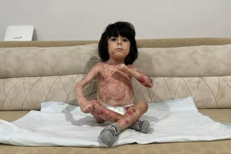 Kelebek hastası minik İbrahim'in acı dolu yaşamı