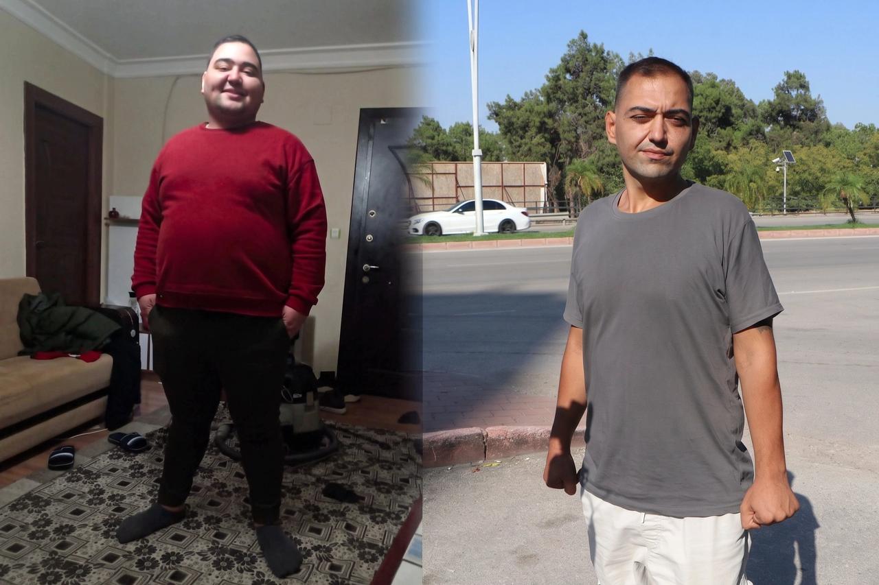 Tüp mide ameliyatı sonrası sağlık sorunları yaşadı: 3 kez ameliyat oldu