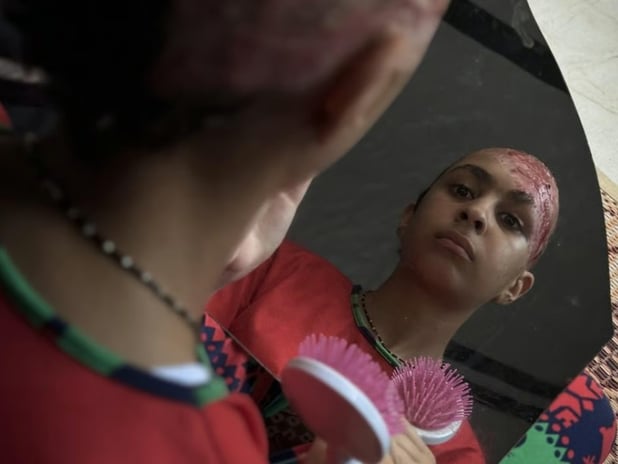 İsrail saldırılarında saçlarını kaybeden Gazzeli çocuk yardım istiyor