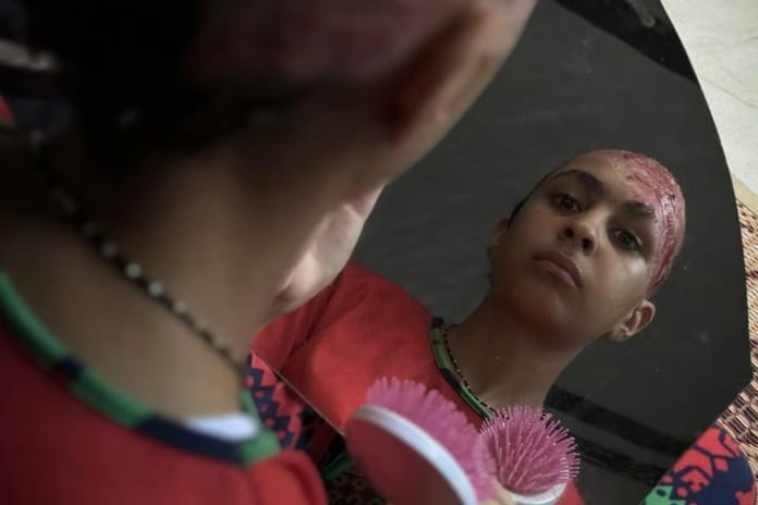 İsrail saldırılarında saçlarını kaybeden Gazzeli çocuk yardım istiyor