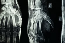 Ortopedide çığır açan buluş: 3 dakikada kırıkları onaran yapıştırıcı