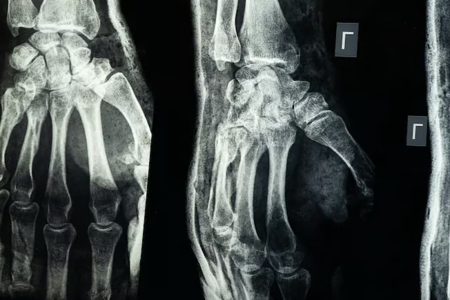 Ortopedide çığır açan buluş: 3 dakikada kırıkları onaran yapıştırıcı