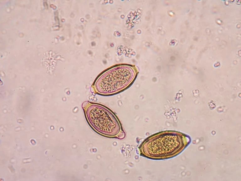 Acanthamoeba keratiti belirtileri nedir