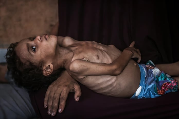 Gazze'de açlıktan ölen Filistinli sayısı 281'e yükseldi