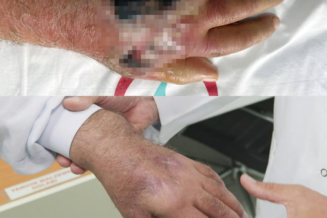 İnsan ısırığında nadir vaka!