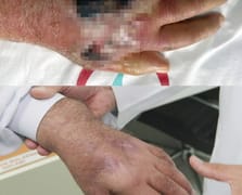 İnsan ısırığında nadir vaka: Amputasyondan kurtuldu