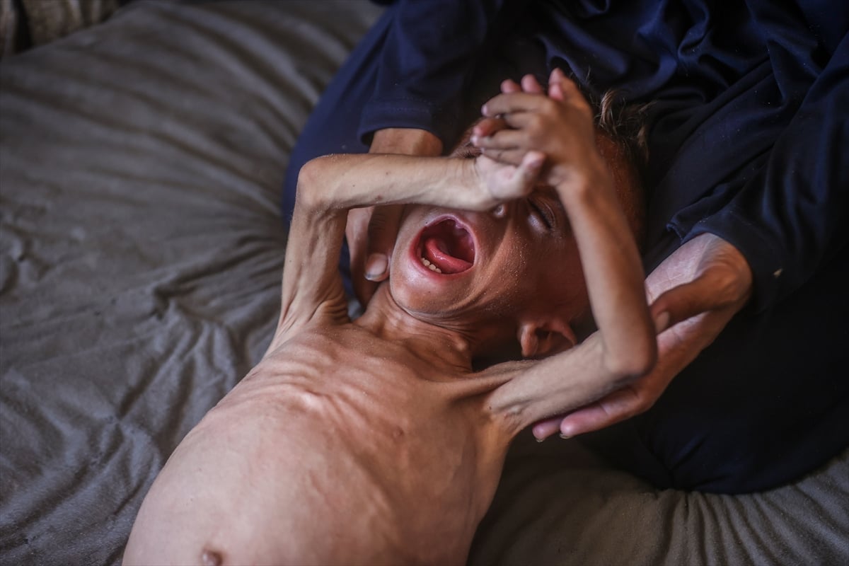 Gazze'de yetersiz beslenme sorunu yaşayan çocuk, ölüm tehlikesiyle karşı karşıya. (AA)