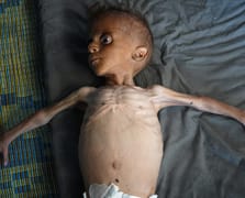 Gazze'de açlıktan ölenlerin sayısı 339'a yükseldi