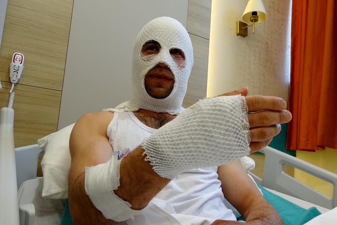 Hediye hazırlığında patlayan sprey boya hastanelik etti