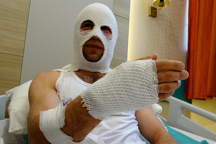 Hediye hazırlığında patlayan sprey boya hastanelik etti