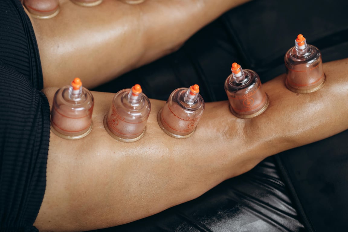 Close-up of cupping therapy on legs, highlighting natural healing and recovery benefits.
