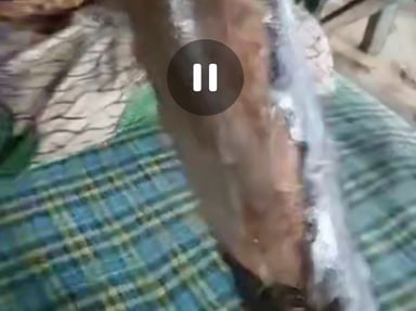 Brûlé au 3ème degré