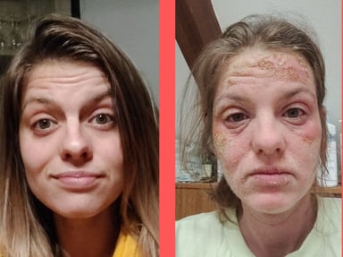 Aidez Virginia à (Re)Vivre (sevrage de cortisone - TSW)
