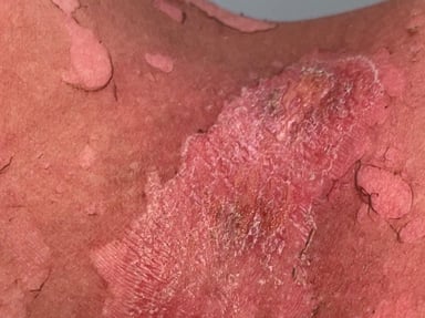 Aider les personnes marquées par les traitements contre le cancer :Radiothérapie