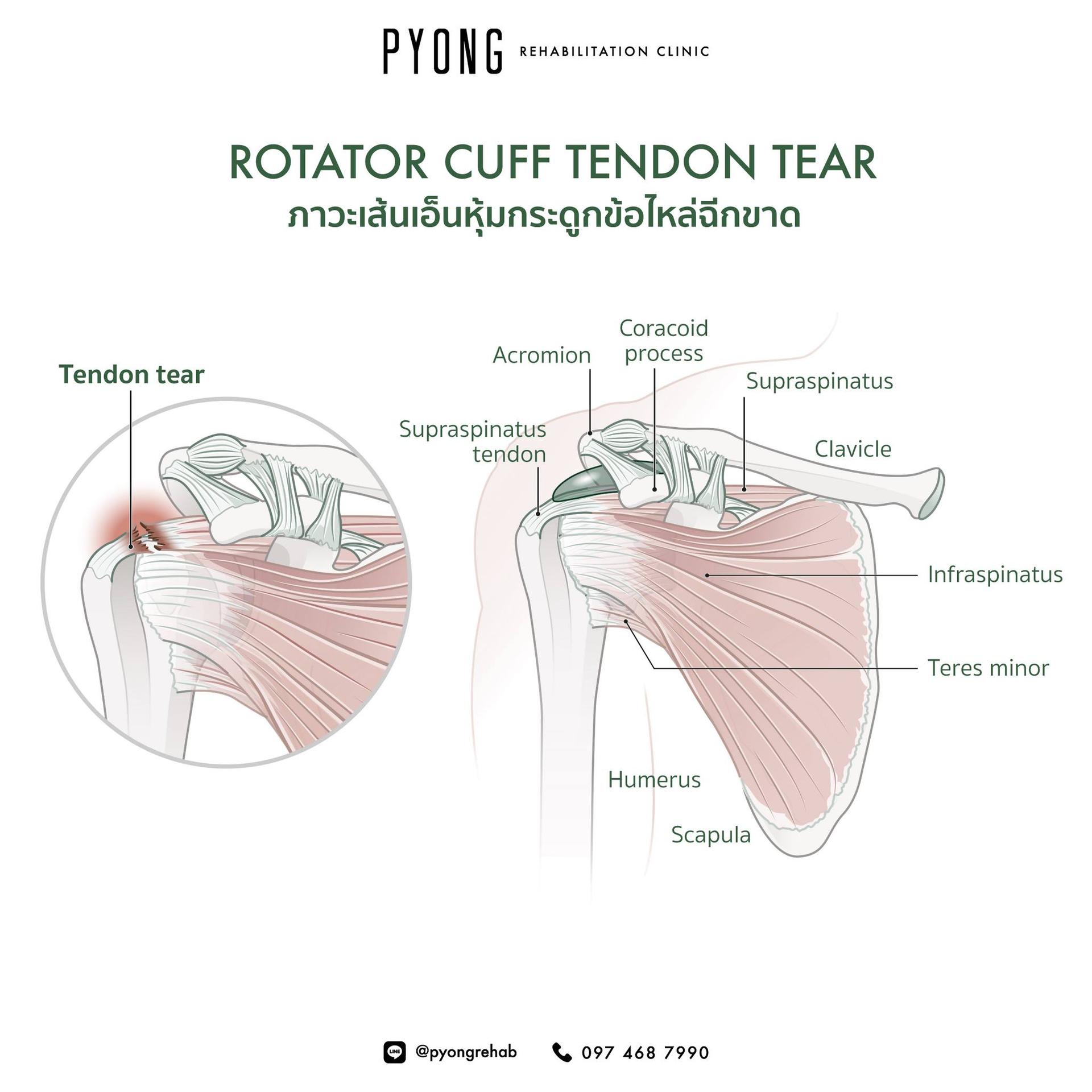 แผนภาพกายวิภาคเส้นเอ็นหุ้มข้อไหล่และตำแหน่งที่เกิดการฉีกขาด