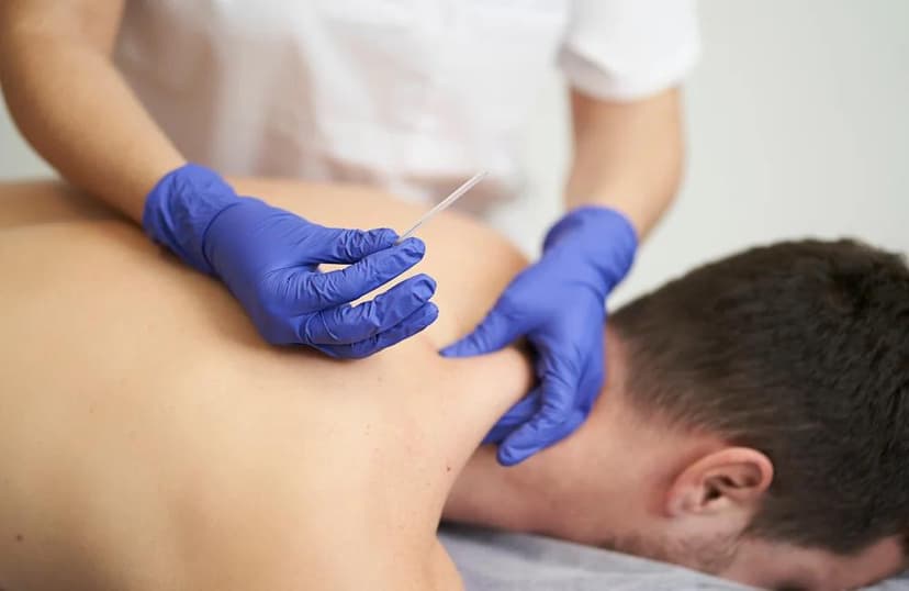 ภาพการรักษาด้วยเทคนิค Dry Needling