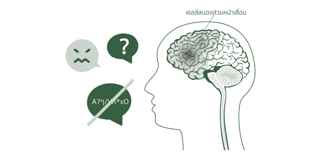 แผนภาพสมองแสดงตำแหน่งสมองกลีบหน้าและกลีบขมับที่ได้รับผลกระทบจาก FTD