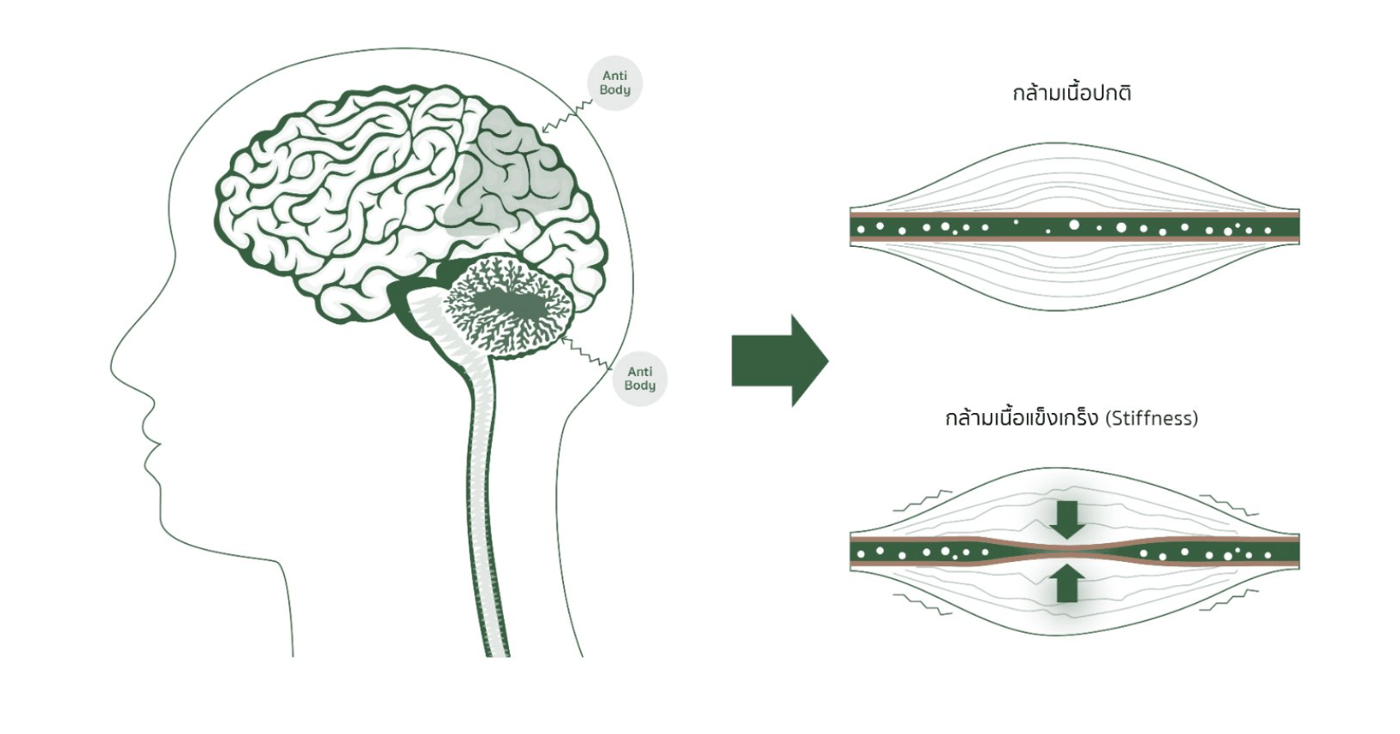ภาพประกอบบทความเกี่ยวกับกลุ่มอาการกล้ามเนื้อเกร็งแข็ง Stiff Person Syndrome
