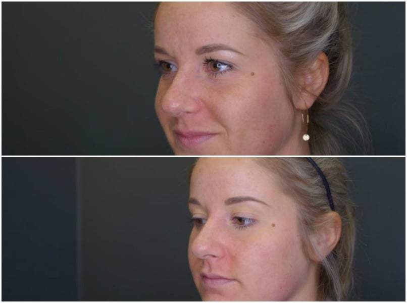 <who>Photo Credit: Lakeshore Vein & Aesthetics Clinic</who> Top: Before, Bottom: After (Wearing no face makeup in both photos, one month after treatment)