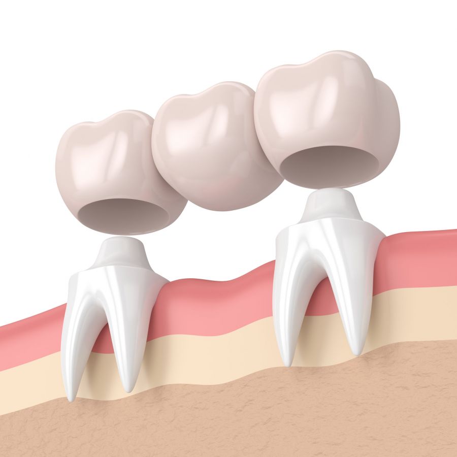 Dental bridge
