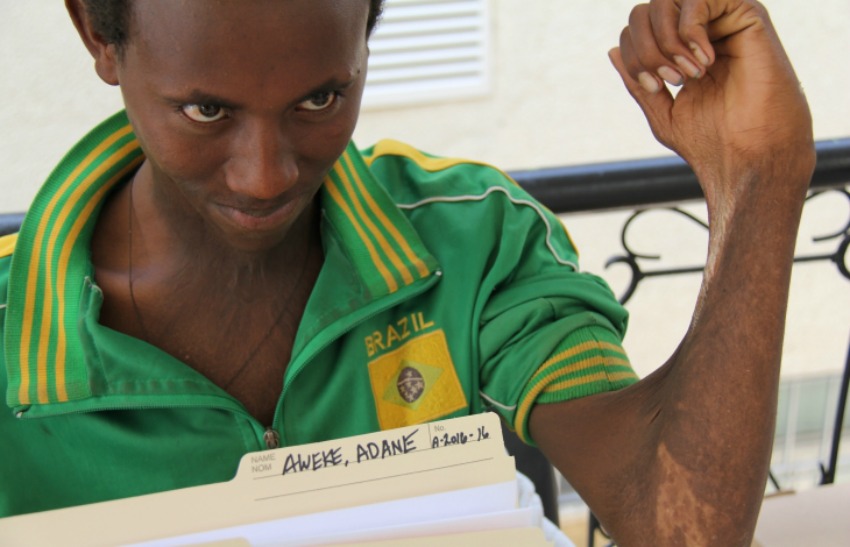 <who> Photo Credit: RESTOR International </who> Adane Aweke before the surgery on his arm. 