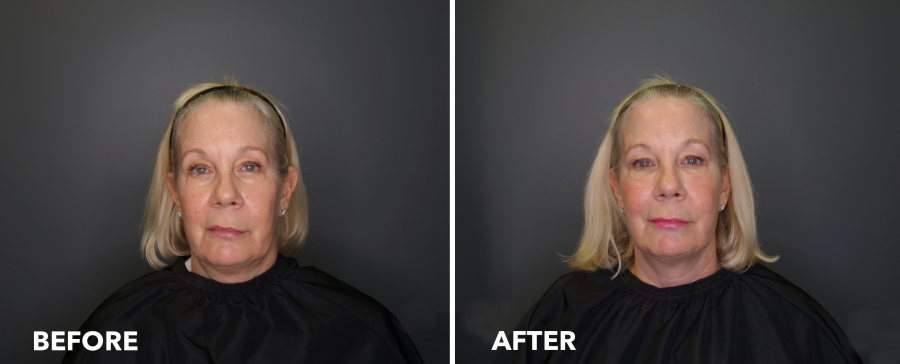 <who>Photo Credit: Lakeshore Vein & Aesthetics Clinic</who> Soft Lift before & after
