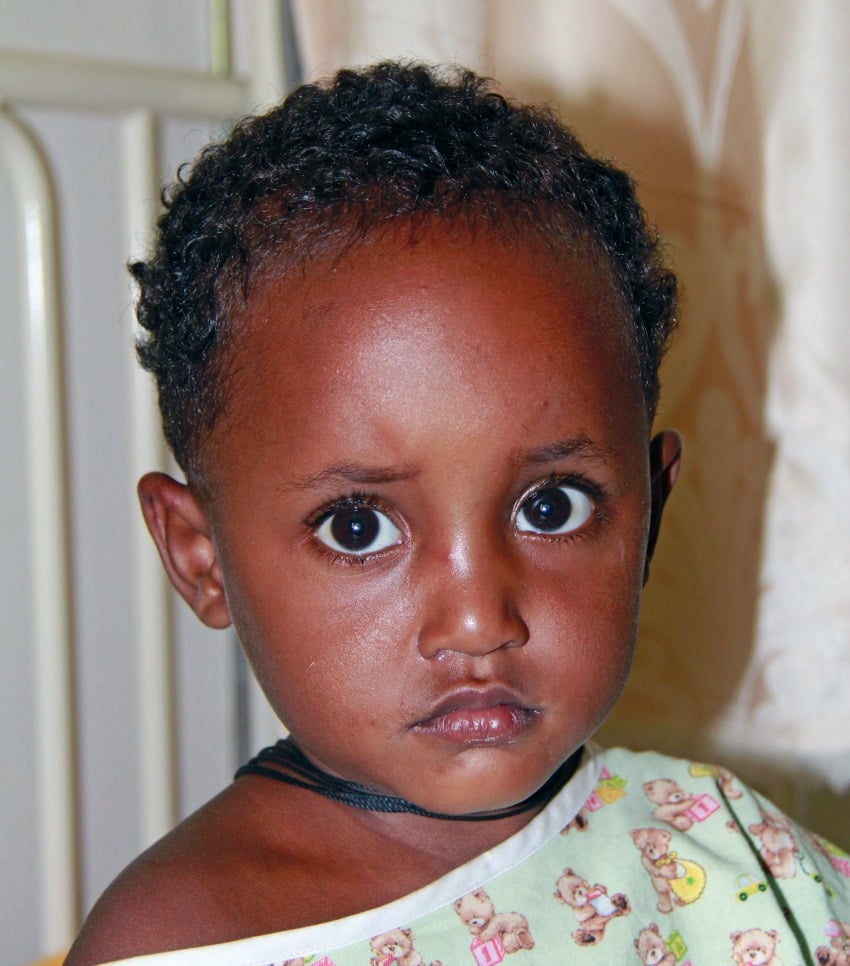<who> Photo Credit: RESTOR International <who> Legese Anerto was six-months-old when she fell into a cooking fire, which caused her fingers to fuse together.