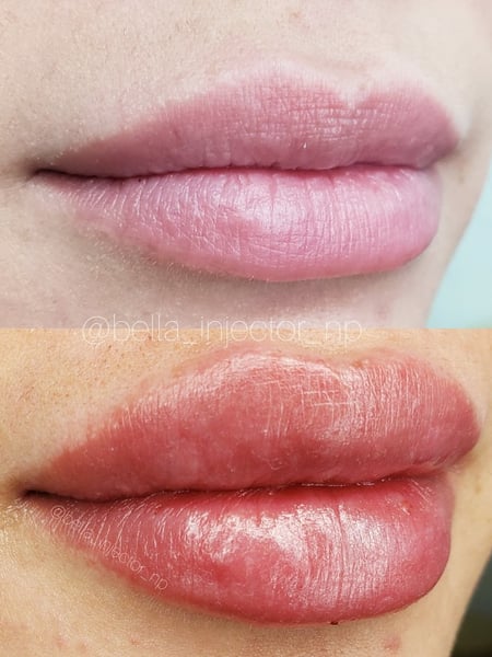 Image of  Cosmetic, Filler, Lips