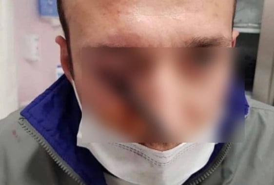 *GRAPHIC WARNING* Always Wear Eye Protection When Shooting