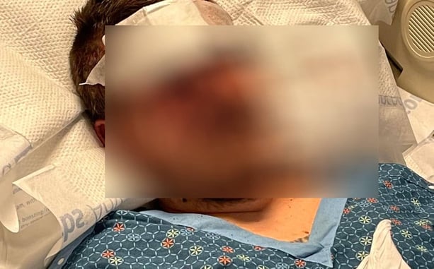 Why We Carry: Man Beaten Nearly To Death By Group Of Teens On Anna Maria Island