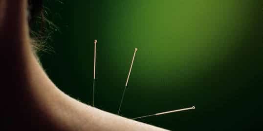 Everything You Need to Know About Using Acupuncture for Pain Management | Acupuncture in Milwaukee, WI
