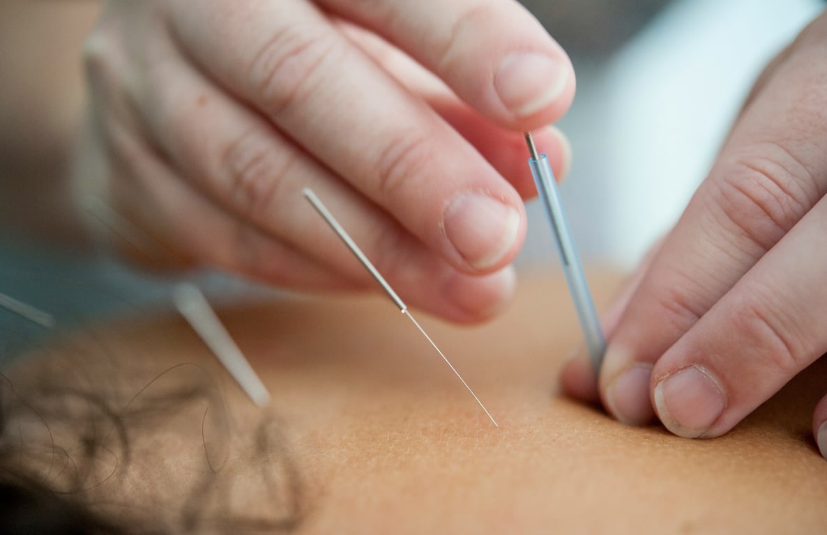 An image of a person receiving acupuncture for low back pain.