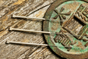 Dry Needling vs. Acupuncture