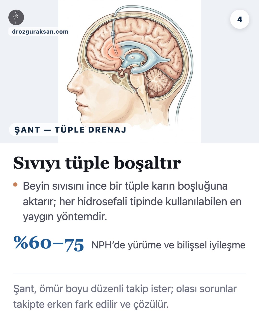 Hidrosefali Tedavisi: Şant ve ETV Yöntemlerinin Karşılaştırılması (2026) — görsel özet kartı 4