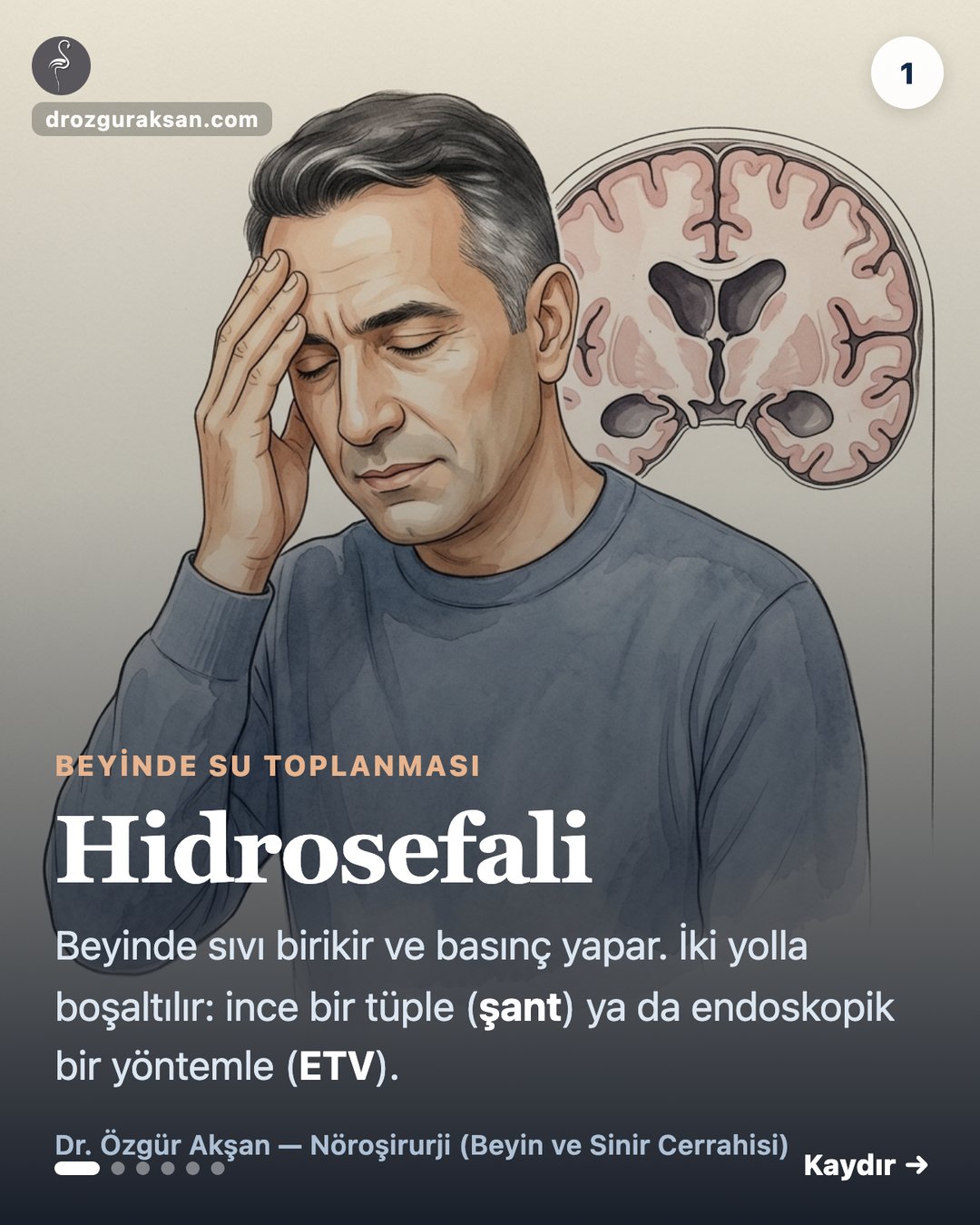 Hidrosefali Tedavisi: Şant ve ETV Yöntemlerinin Karşılaştırılması (2026) — görsel özet kartı 1
