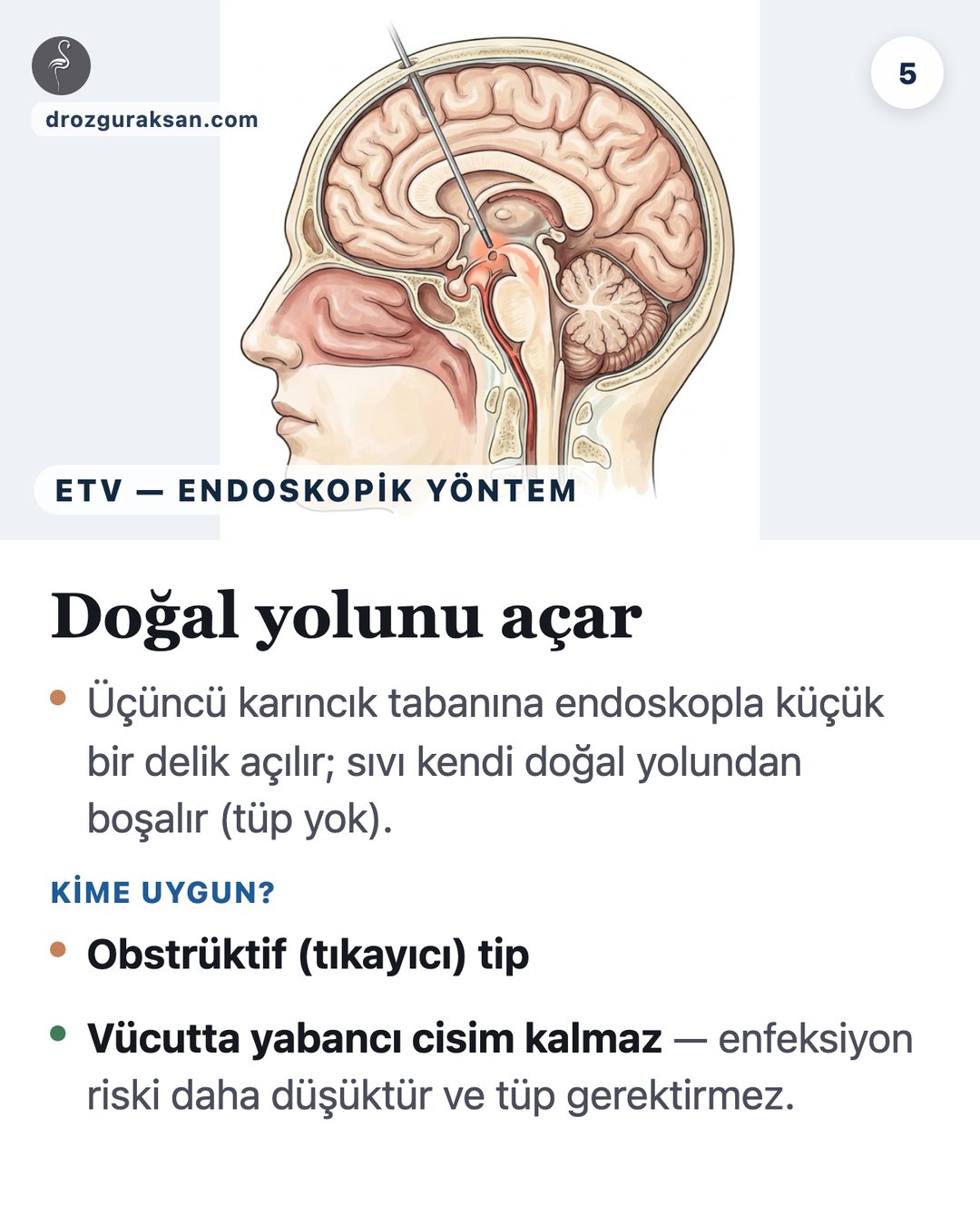 Hidrosefali Tedavisi: Şant ve ETV Yöntemlerinin Karşılaştırılması (2026) — görsel özet kartı 5