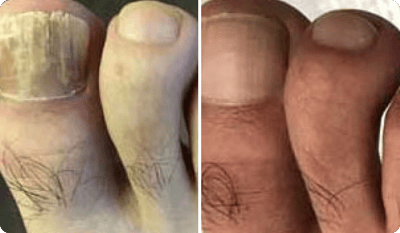 Manfred Braun Vorher Nachher