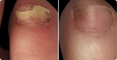 Günter Fischer Vorher Nachher