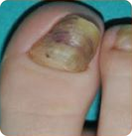 Hypertrophie der Nagelplatte