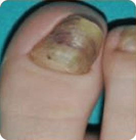 Hypertrophie der Nagelplatte