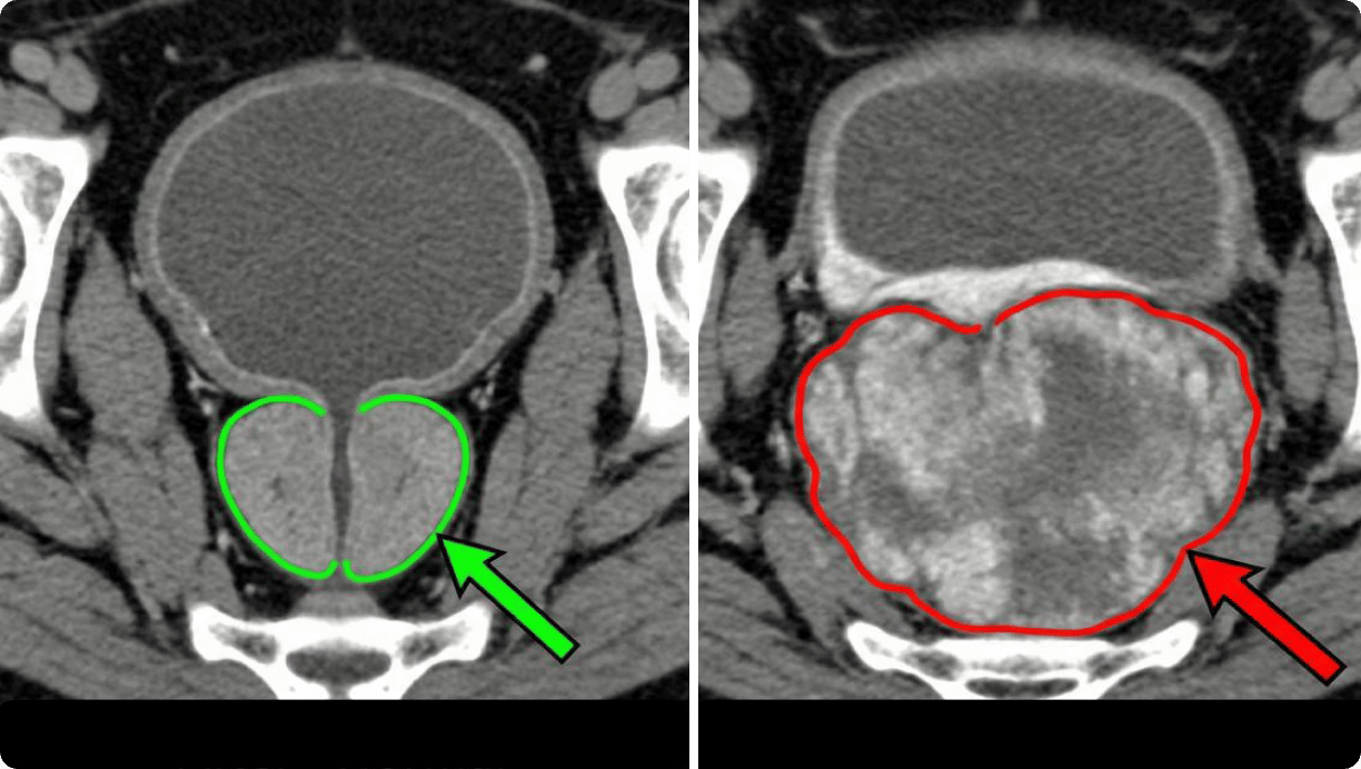 Prostate comparison