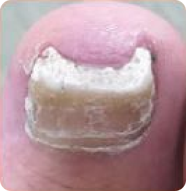 Distale subunguale Onychomykose