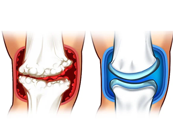 arthroease-joint-relief