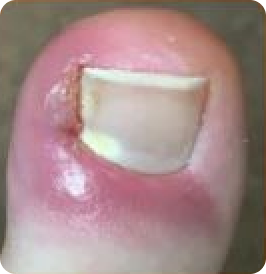 Eingewachsener Zehennagel