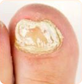 Weiße oberflächliche Onychomykose
